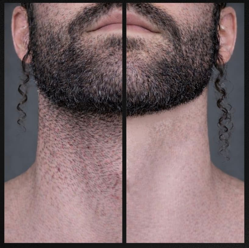 Laser hair removal before and after — beard and neckline